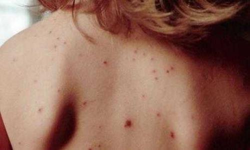 Точка черная под кожей. Как лечится бородавки и бородавки? 01 Точка черная под кожей. Как лечится бородавки и бородавки? 01