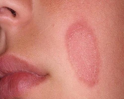 Детский крем от покраснений на лице. Как избавиться от покраснения кожи на лице