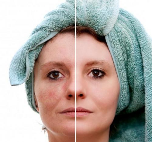 Кровеносные сосуды на лице. Укрепление сосудов 07