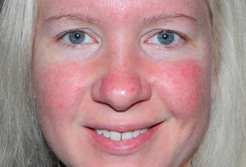 Уход за тонкой кожей лица в домашних условиях - рецепты масок 01