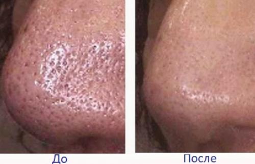 Как очистить поры на носу от жира. Как почистить поры?