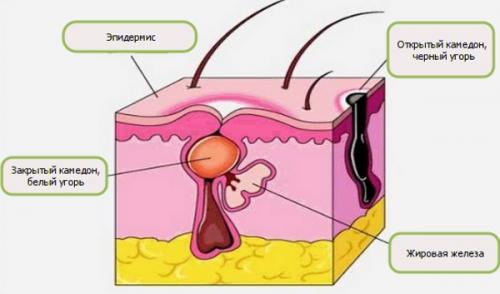 Расширенные поры с возрастом. Расширенные поры на лице: причины