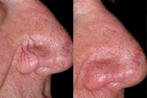 Лазерное удаление сосудов на лице противопоказания. После удаления сосудов