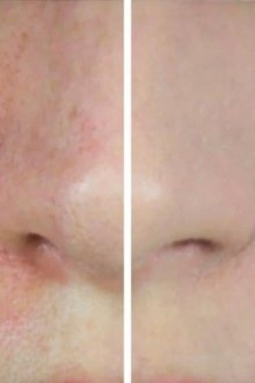 Средства сужающие поры. Крем, сужающий поры на лице: всем ли нужен и как найти подходящий