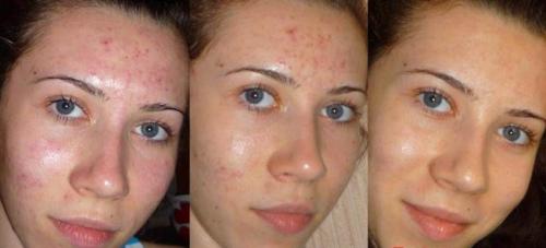 Пористая кожа лица жирная. О причинах 07 Пористая кожа лица жирная. О причинах 07