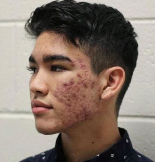 Средства по уходу за кожей лица для подростков. Что делать с проблемной кожей лица подростку