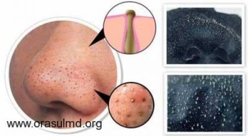 Как убрать черные точки на носу содой.