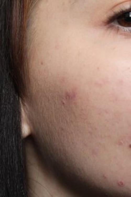 Сужает поры на лице средства. Крем, сужающий поры на лице: всем ли нужен и как найти подходящий