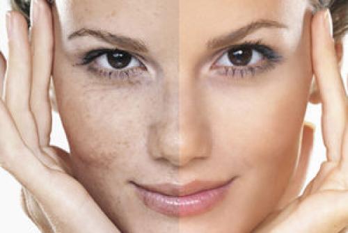 Как замаскировать пигментные пятна на лице. Невидимый секрет: лучшие способы замаскировать пигментные пятна на лице 03