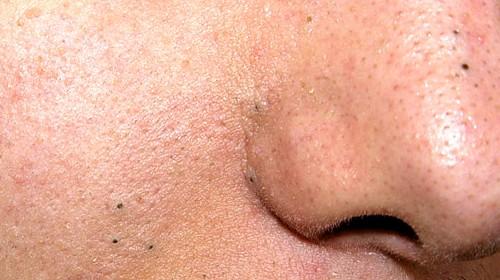 Черные точки на щеках, как избавиться. Как избавиться от черных точек на щеках