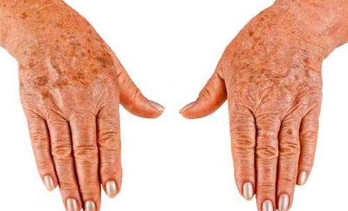 Как замаскировать пигментные пятна на лице. Невидимый секрет: лучшие способы замаскировать пигментные пятна на лице 04 Как замаскировать пигментные пятна на лице. Невидимый секрет: лучшие способы замаскировать пигментные пятна на лице 04