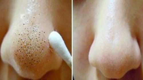 Как в домашних условиях убрать черные точки с лица. Как убрать черные точки в домашних условиях 02