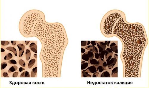 Вымывает ли кофе кальций из организма. В чем опасность потери кальция?