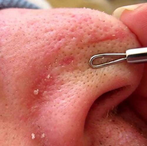 Как убрать черные точки с носа в домашних условиях. Как убрать черные точки на носу в домашних условиях — быстро и эффективно 10 Как убрать черные точки с носа в домашних условиях. Как убрать черные точки на носу в домашних условиях — быстро и эффективно 10