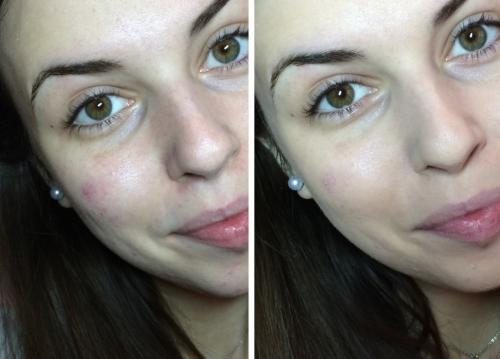 Как уменьшить поры на лице в домашних условиях и эффективно форум. Как сузить поры на лице: 4 лайфхака