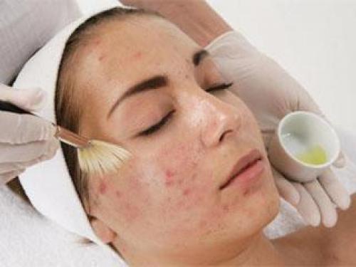 АНА-кислоты для лица. 3 вида пилинга 02