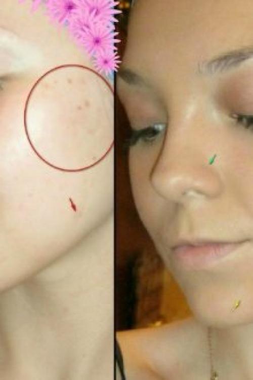 Корректор для лица зеленый, как пользоваться. Зеленый консилер для лица – идеальное средство маскировки недостатков кожи