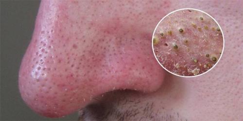 Черные точки, как избавиться. Черные точки на коже лица - как избавиться в домашних условиях косметическими и народными средствами