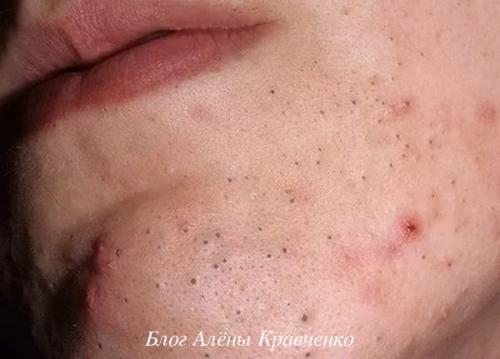 Уход за кожей черные точки. Черные точки — поможет только правильный уход за кожей 04