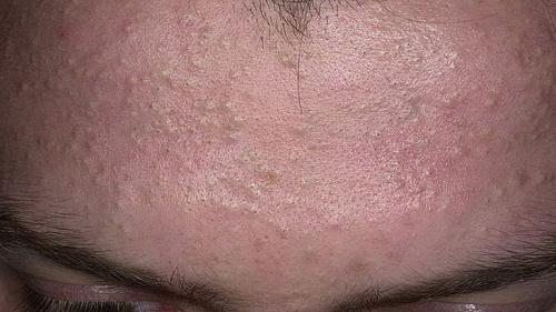 Как бороться с прыщами на лбу. Медикаментозные средства 04 Как бороться с прыщами на лбу. Медикаментозные средства 04