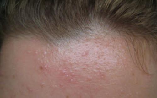 Как избавиться от прыщей на лбу. Как избавиться от мелких прыщей на лбу?