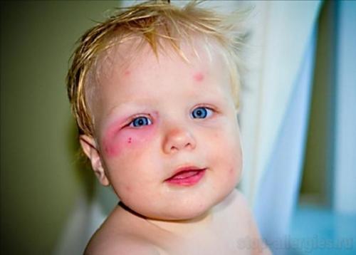 Укусил комар в губу. Чем опасен укус мошки 02 Укусил комар в губу. Чем опасен укус мошки 02