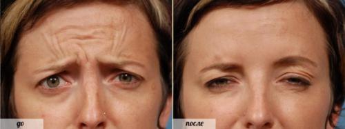 Морщина на переносице вдовий мост. Убрать морщины ботоксом