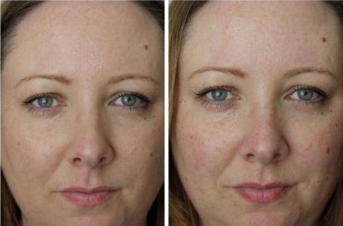 Мазь от купероза на лице в аптеке. «Vichi Idealia Pro» – крем-сыворотка для устранения купероза