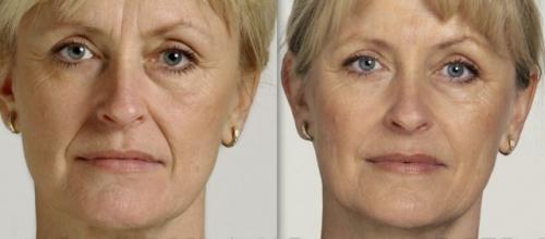 Морщина на переносице вдовий мост. Убрать морщины ботоксом