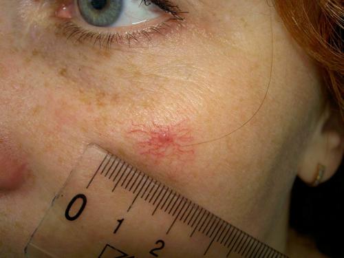 Пилинг лица дома с медом. Пилинг мёдом