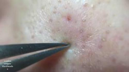 Выдавливание черных точек стержнем. Можно ли выдавливать чёрные точки 02 Выдавливание черных точек стержнем. Можно ли выдавливать чёрные точки 02