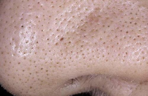 Черные точки. Из-за чего появляются черные точки