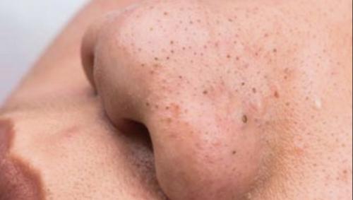 Черные точки. Из-за чего появляются черные точки