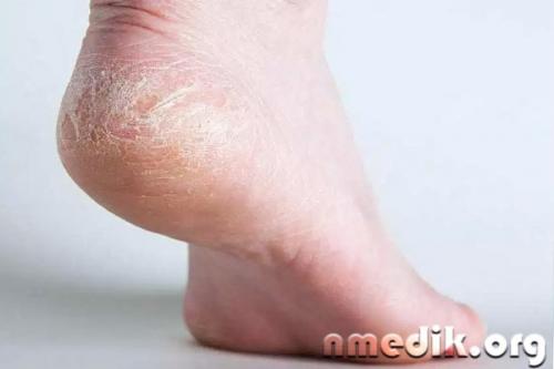 Сухая кожа ног и рук. Причины сухости кожи рук и ног