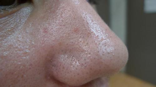 Этапы ухода за комбинированной кожей. 6 основных этапов ухода за комбинированным типом кожи лица