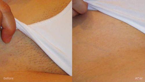 Как сделать эпиляцию в интимной зоне в домашних условиях. Как делают депиляцию в интимных местах