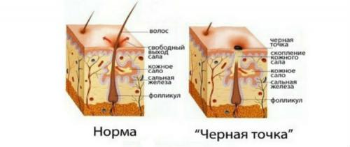 Как очистить поры от черных точек. Как эффективно очистить поры на лице и убрать черные точки доступными средствами