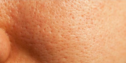 Расширенные поры, как убрать. Как помочь коже в домашних условиях? 02 Расширенные поры, как убрать. Как помочь коже в домашних условиях? 02