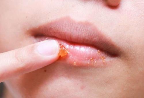 Скраб из меда для губ. Скраб для губ из меда своими руками