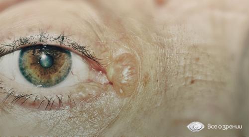 Желтые пятна под глазами. Под глазами на веках желтые пятна – о, какой болезни они говорят? 08 Желтые пятна под глазами. Под глазами на веках желтые пятна – о, какой болезни они говорят? 08