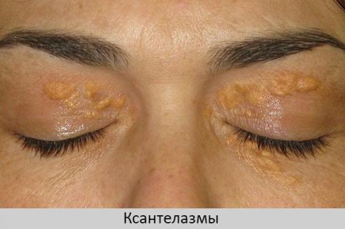 Желтые пятна под глазами. Под глазами на веках желтые пятна – о, какой болезни они говорят?