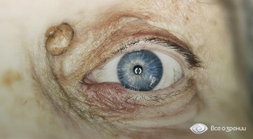 Желтые пятна под глазами. Под глазами на веках желтые пятна – о, какой болезни они говорят? 07 Желтые пятна под глазами. Под глазами на веках желтые пятна – о, какой болезни они говорят? 07