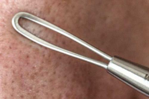 Удаление черных больших точек. Причины появления черных точек 01