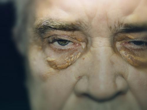 Желтые пятна под глазами. Под глазами на веках желтые пятна – о, какой болезни они говорят? 05 Желтые пятна под глазами. Под глазами на веках желтые пятна – о, какой болезни они говорят? 05