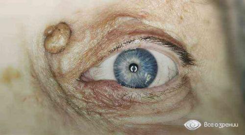 Желтые пятна под глазами причина печень. Причины желтых пятен под глазами