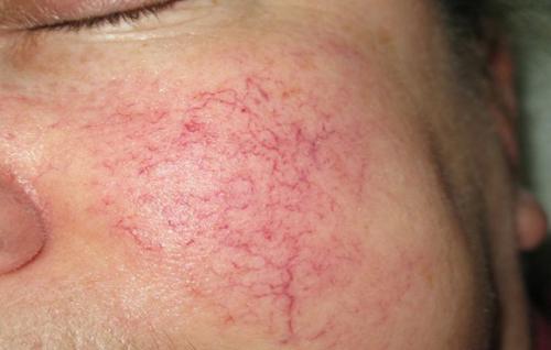 Лопнул сосуд на лице чем мазать. Что делать если полопались капилляры на лице и как избавится от лопнувших сосудов