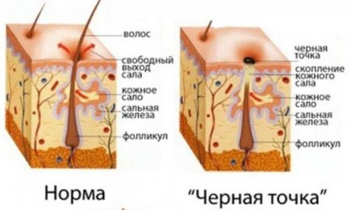 Как убрать черные точки на носу у подростка в домашних условиях. Причины появления черных точек на носу