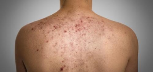 Глубокая черная точка на спине. Клиническая картина