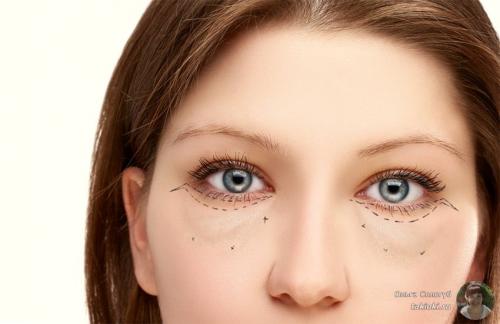 Желтые мешки под глазами у мужчин. Предупреждаем желтые пятна под глазами у женщин и мужчин