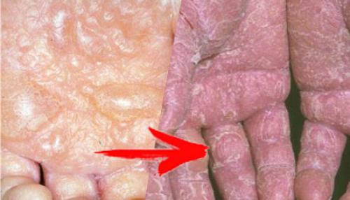 Экзема кожи рук. Причины экземы на руках + факторы риска